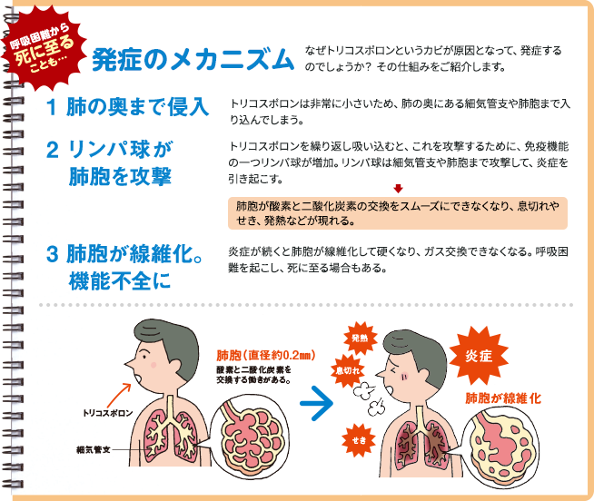 呼吸困難から死に至ることも… 発祥のメカニズム 1.肺の奥まで侵入 2.リンパ球が肺胞を攻撃 3.肺胞が線維化。機能不全に